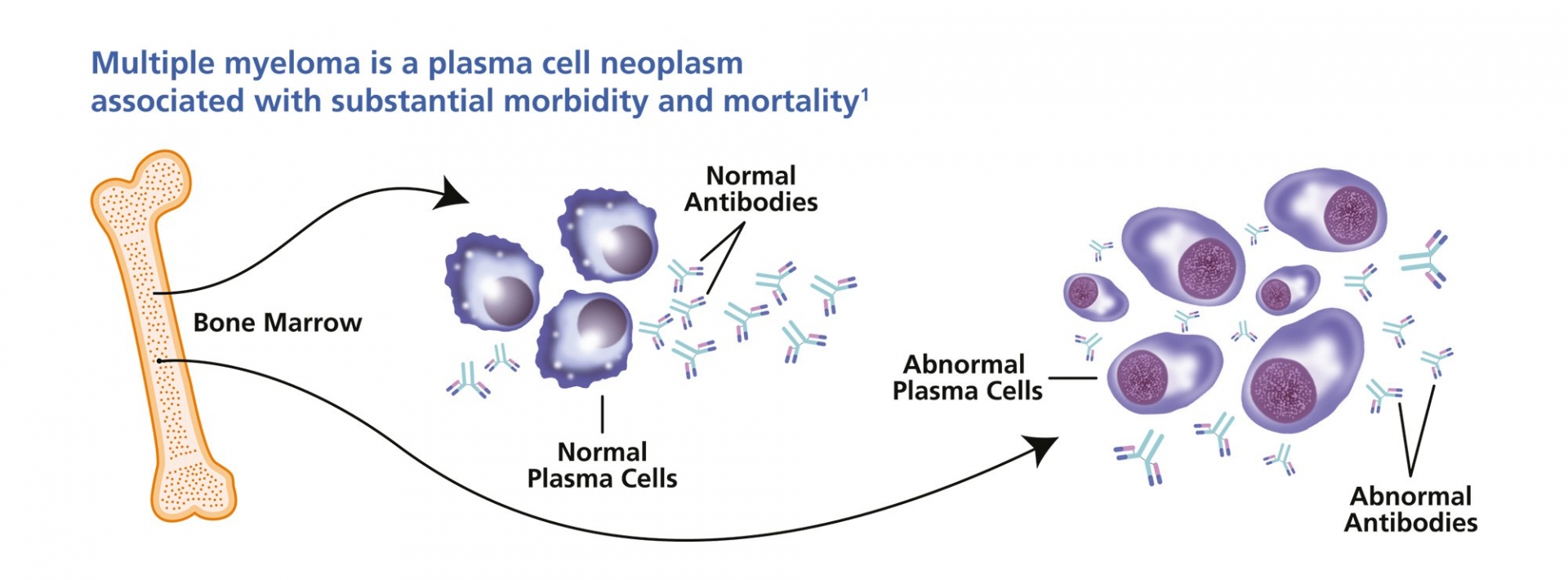 Multiple Myeloma: Symptoms, Causes, Diagnosis and Treatment