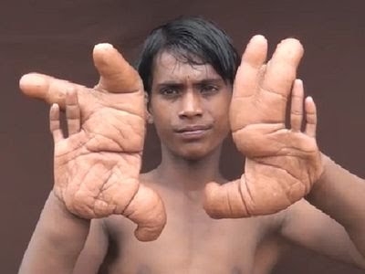 Only in India: Mysterious Condition of Boy with The Most Giant Hands in the World